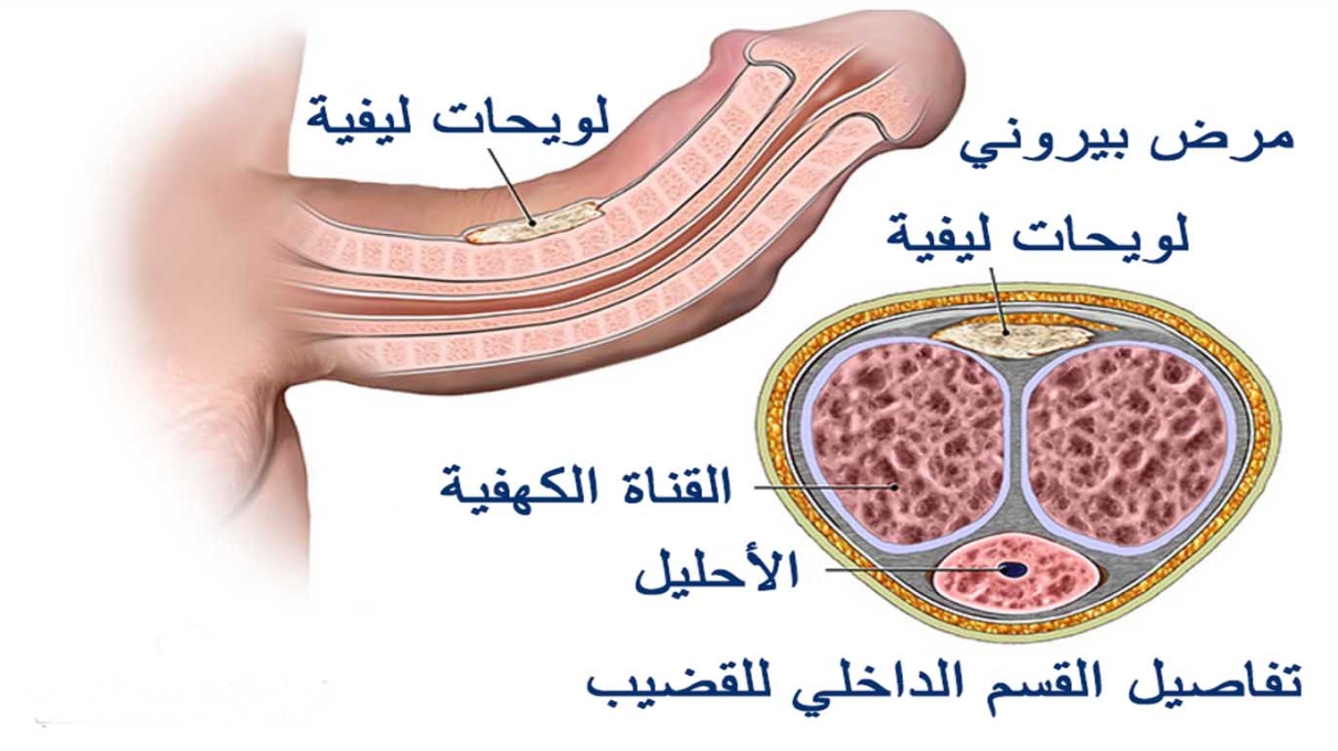 اعوجاج القضيب: الأسباب الكاملة وكل خيارات العلاج الفعالة